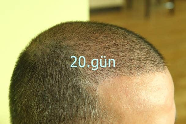 20 days after hair transplant