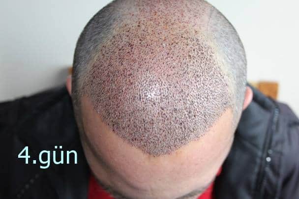 4 days after hair transplant