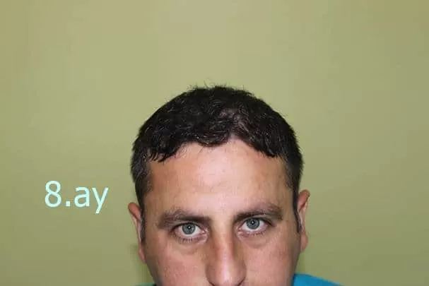 saç ekimi 8.ay