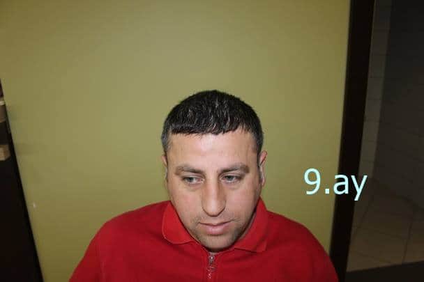 saç ekimi 9.ay