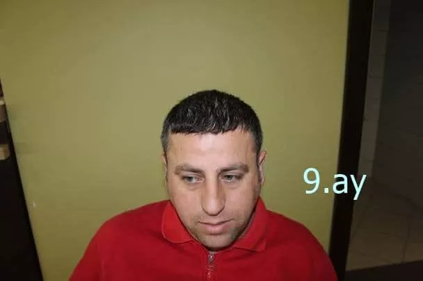 saç ekimi 9.ay
