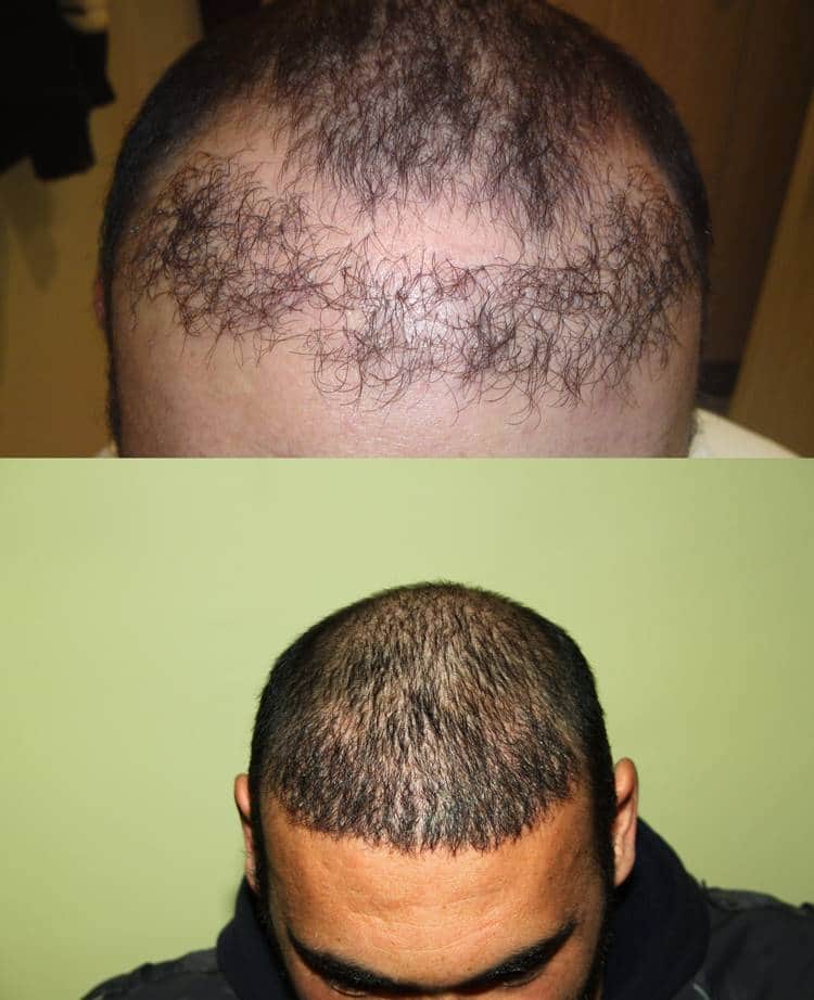 Résultat de correction d’une greffe de cheveux ratée