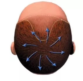 Une répartition des cheveux en toile d'araignée au niveau du vertex