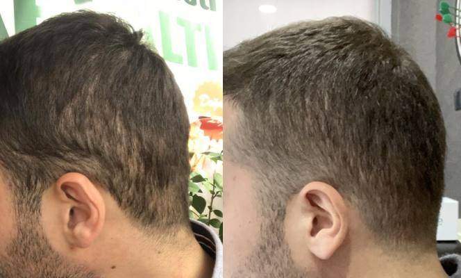 Pluggy Hair Transplant Repair