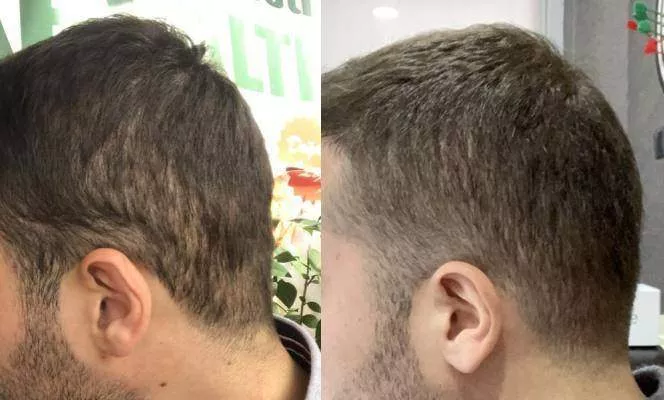 Pluggy Hair Transplant Repair