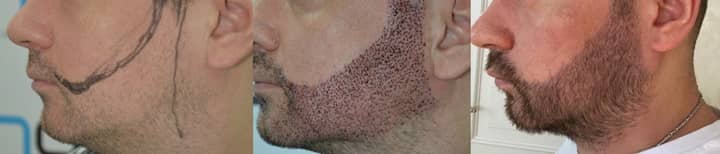 beard hair transplant