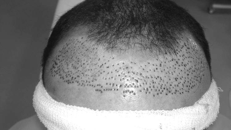 bad hair transplant fix