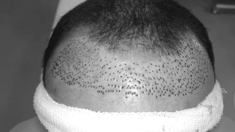 bad hair transplant fix