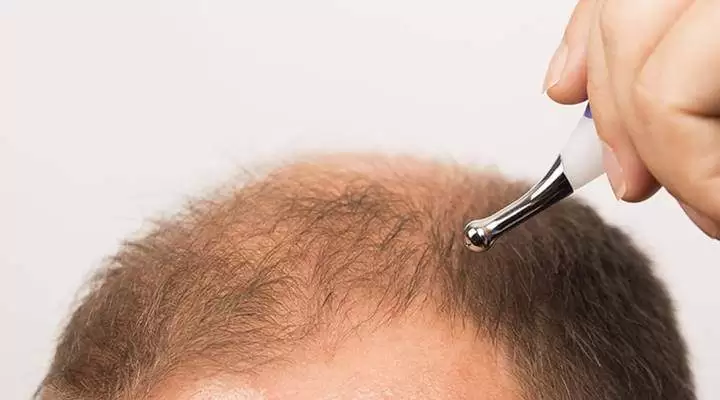 bad-hair-transplant-repair-jpg