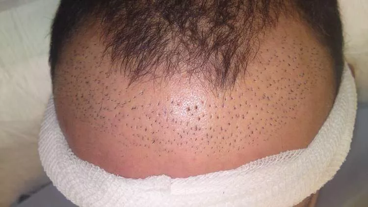 wrong hair transplant image