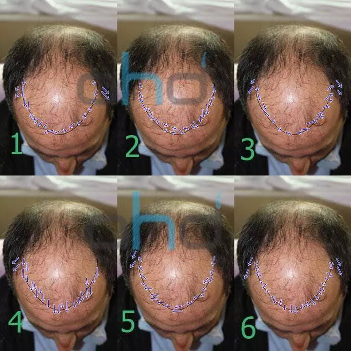 6 directions de pousse distinctes sur la ligne frontale