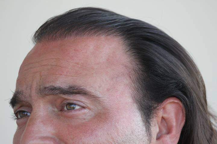 doğal saç çizgisi
