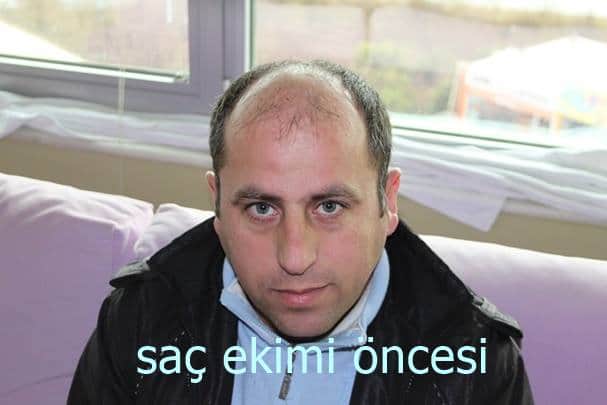 saç ekim öncei