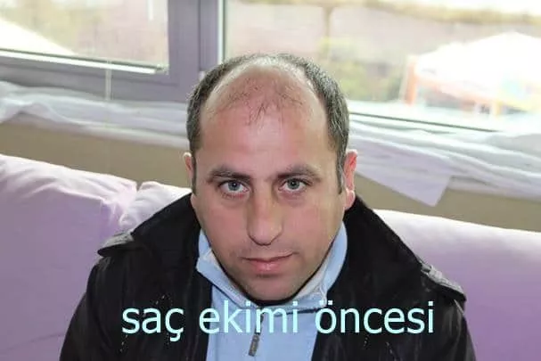 saç ekim öncei