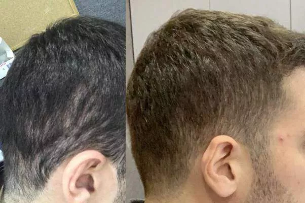 fixing bad hair transplant