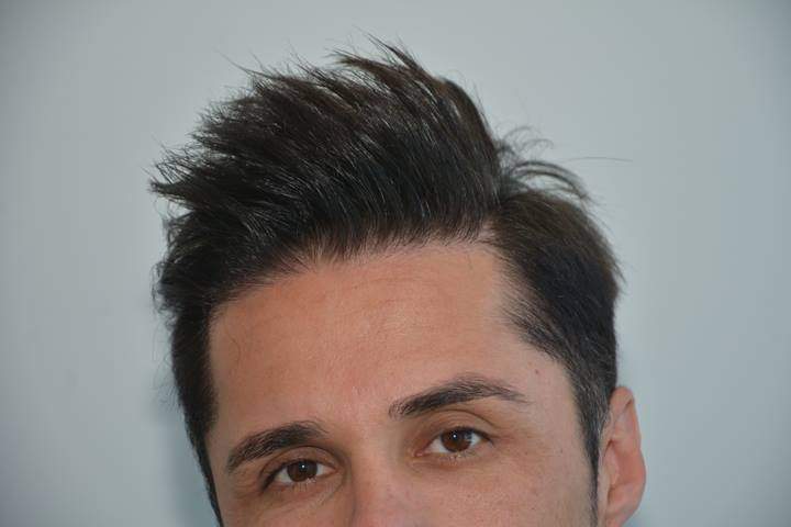 frontal hair transplaant