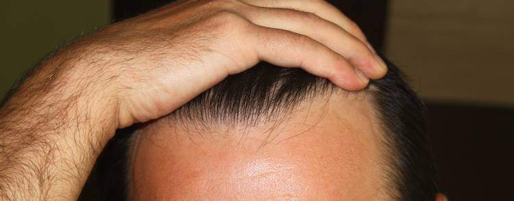 frontal hairline restıration