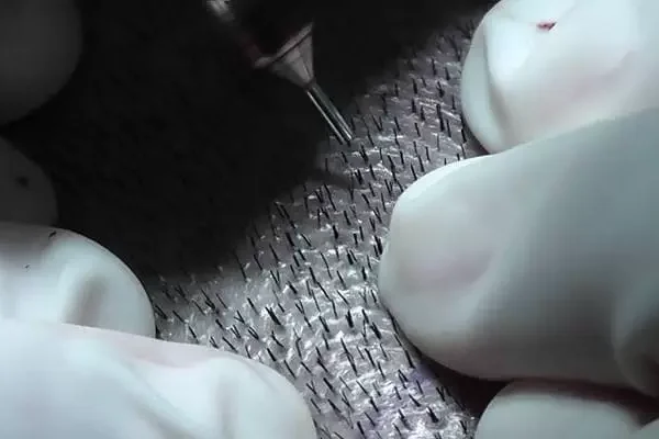 fue-hair-transplant-jpg
