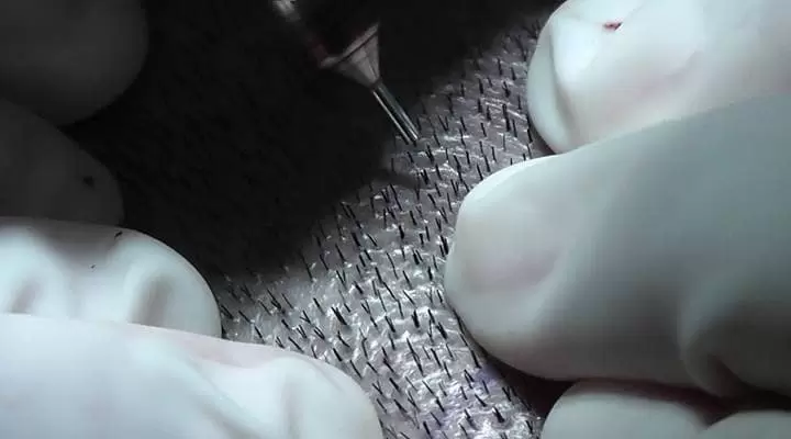 fue-hair-transplant-jpg