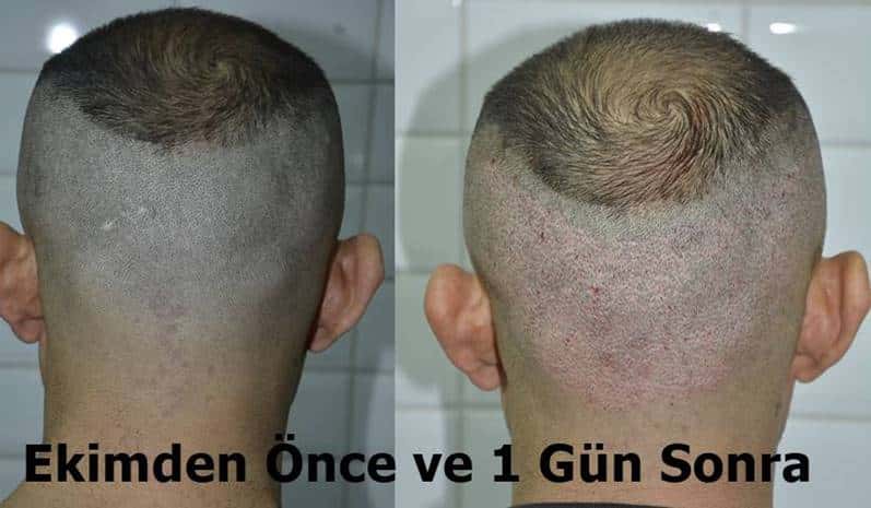 fue saç ekimi donör bölge