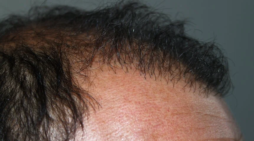 greffe de cheveux ratée