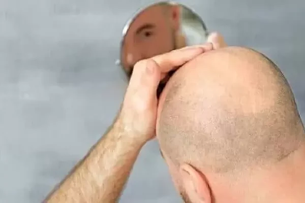 hair-transplant-oedema-jpg