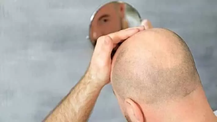 hair-transplant-oedema-jpg