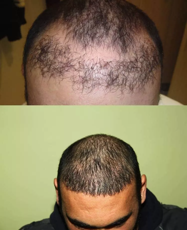 hair transplant repair