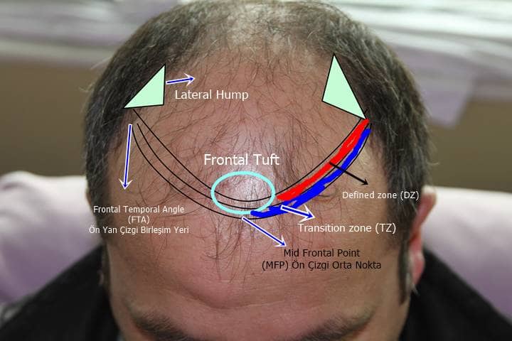 hairline definitions