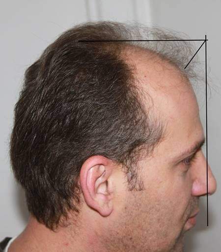 hairline mid point