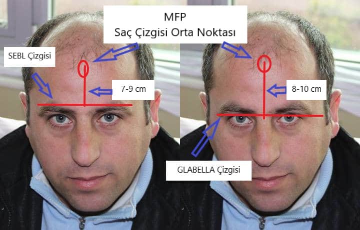 mid frontal point