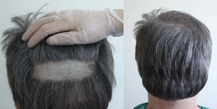 nonshaven hair transplant
