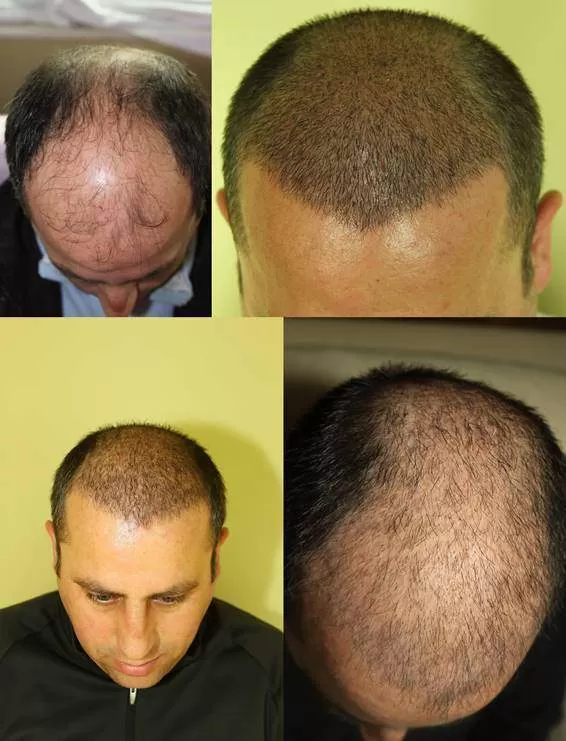 şok dökülme resimleri