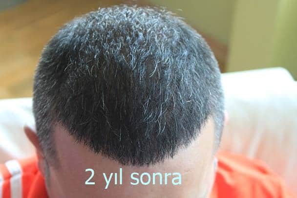 saç ekiminde 2 yıl sonra