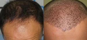 le processus après une greffe de cheveux