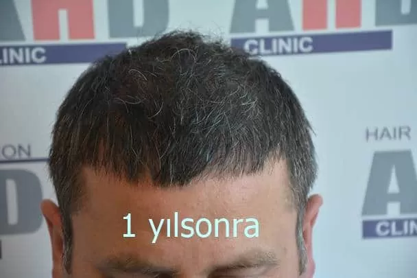 saç ekiminde 1.yıl görüntüsü