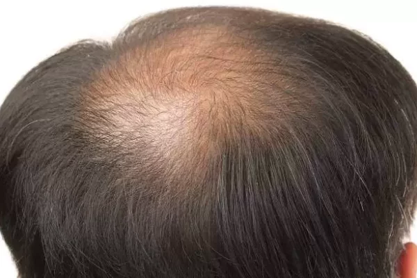 crown-hair-transplant-jpg