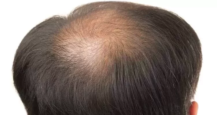 crown-hair-transplant-jpg