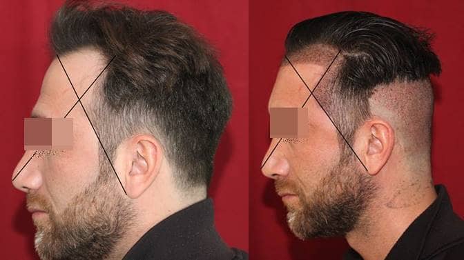 temporal hairline