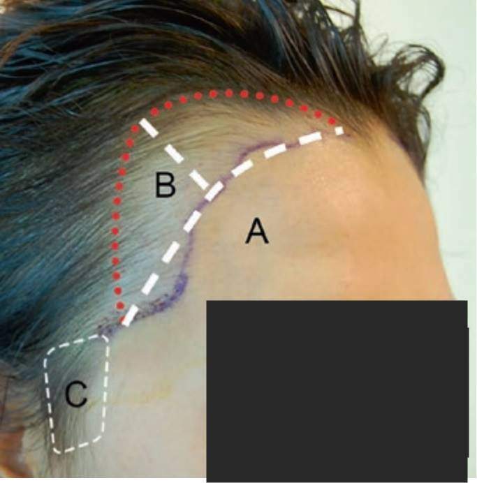 Temple Hair Transplant in Women