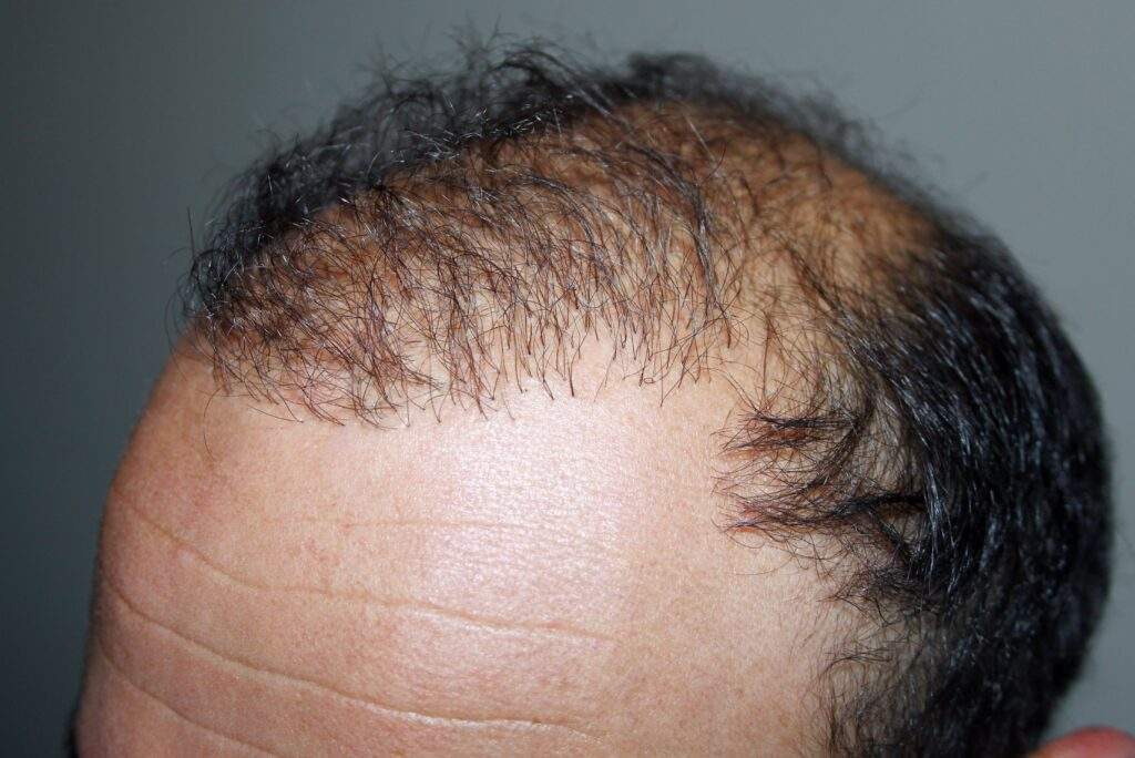 Hair transplant risks
