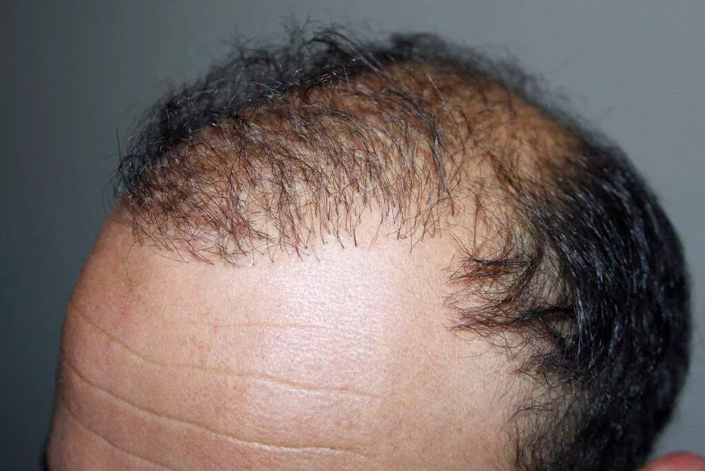 Hair transplant risks