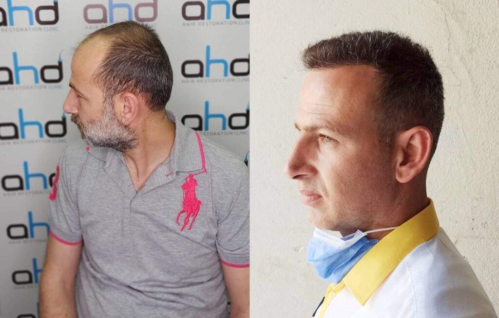 5000 grafts hair restoration 5000 grafts hair restoration