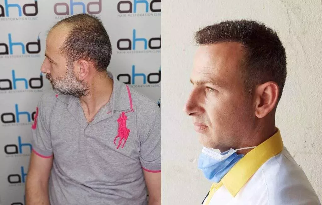 5000 grafts hair restoration 5000 grafts hair restoration