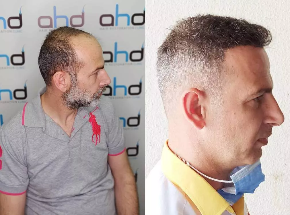 5000 grafts hair transplant 5000 grafts hair transplant