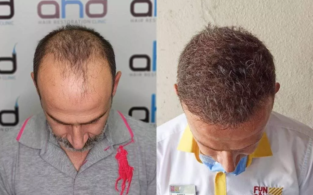 hair transplant 5000 grafts before after hair transplant 5000 grafts before after
