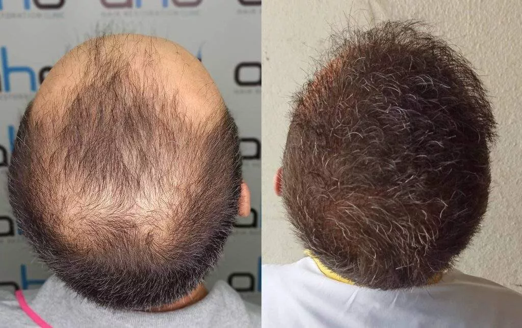 hair transplant 5000 grafts result hair transplant result 5000 grafts