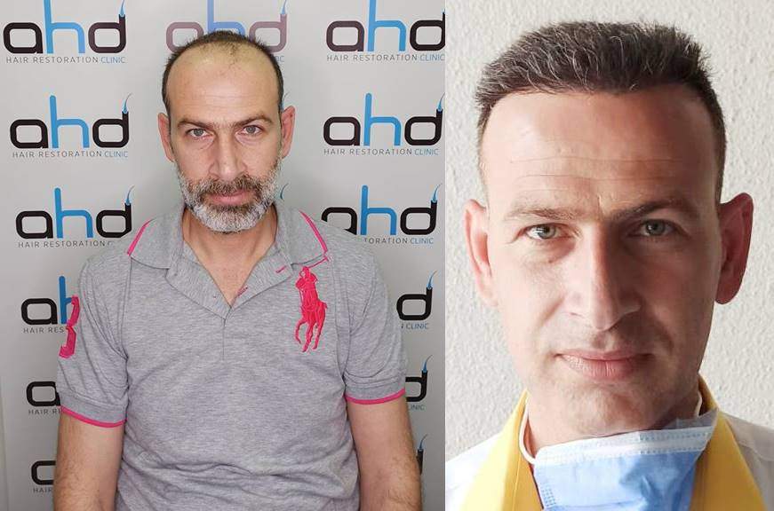 hair transplant 5000 grafts hair transplant before after 5000 grafts