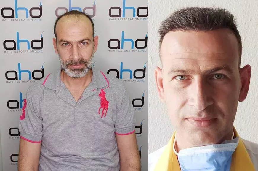 hair transplant 5000 grafts hair transplant before after 5000 grafts