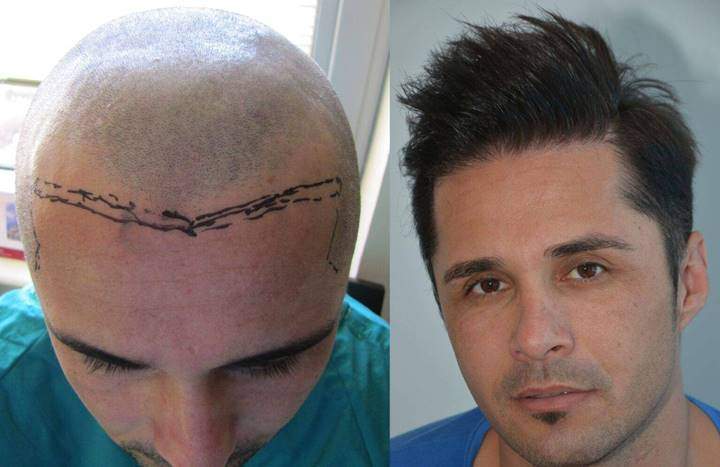 hair transplant regrow